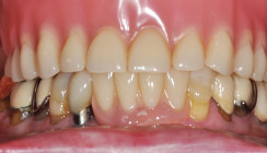 XY ungelöst: Probleme mit ­Attachments für implantatgetragene Deckprothesen