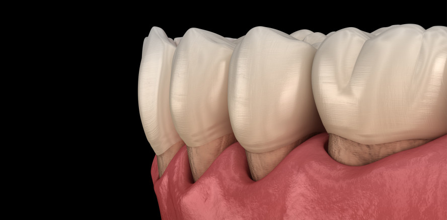 Umfangreicher Zahnerhalt durch Parodontitisbehandlung