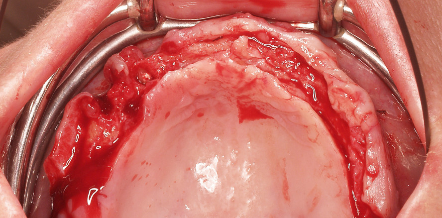 Implantatbrücke im zahnlosen Oberkiefer ohne Augmentation