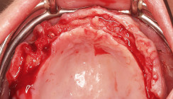 Implantatbrücke im zahnlosen Oberkiefer ohne Augmentation