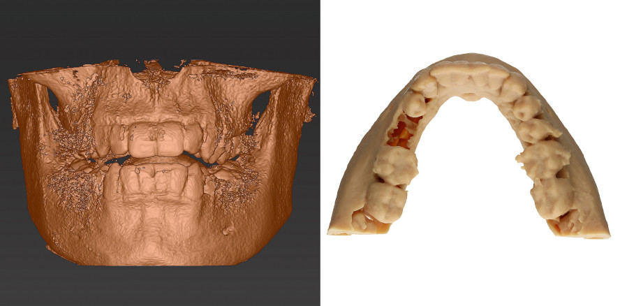 Zahntransplantation und 3-D-Planung