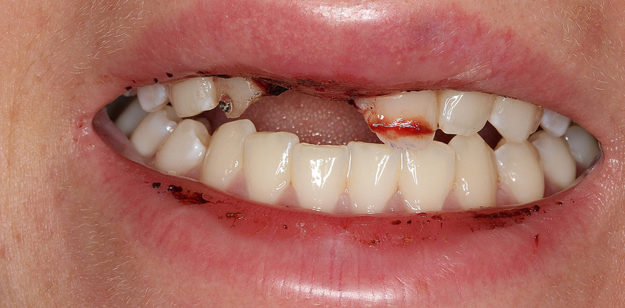 Kosmetische und funktionelle Rehabilitation nach Zahnunfall