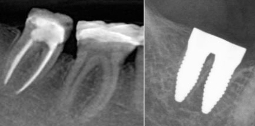 Zweiwurzlige Keramikimplantate für die Sofortimplantation