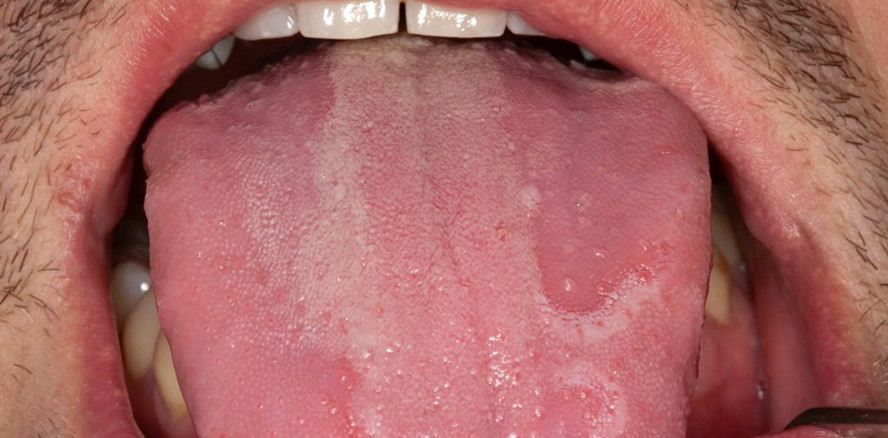 Wund im Mund – Es ist zum Glück nicht immer Krebs