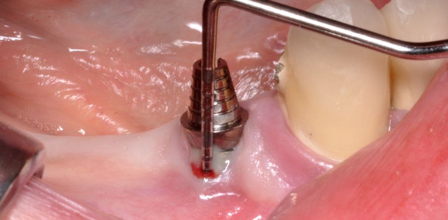 Chirurgische Periimplantitistherapie von Implantatoberflächen