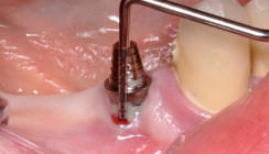 Chirurgische Periimplantitistherapie von Implantatoberflächen