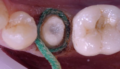 Vereinfachter Workflow bei der postendodontischen Versorgung