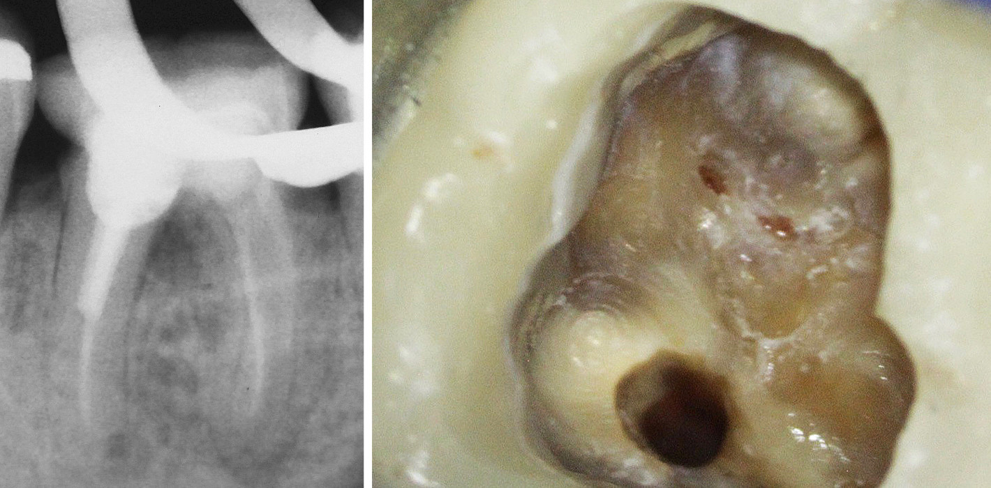 Einsatz kalziumsilikatbasierter Materialien in der Endodontie