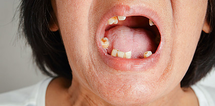 48 Jahre Zahnarztpause – heute gibt’s nur noch Brei