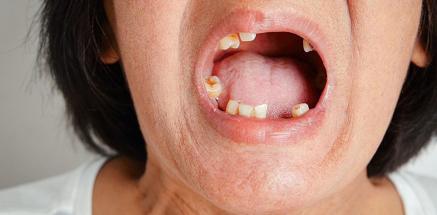 48 Jahre Zahnarztpause – heute gibt’s nur noch Brei