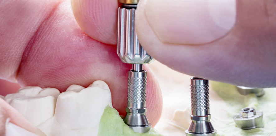 Auswechseln von Abutments: GOZ-Nr. 9040, 9050, 9060 oder analog?