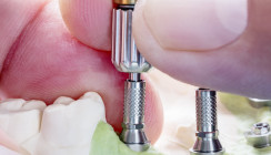 Auswechseln von Abutments: GOZ-Nr. 9040, 9050, 9060 oder analog?