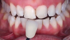 Ästhetik braucht Zeit: Multidisziplinärer Fall von Engstand