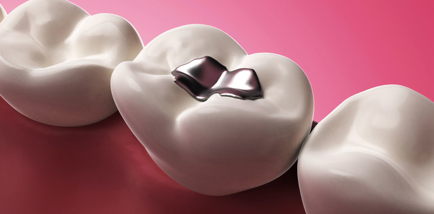 Amalgam: Zahnärzteschaft lehnt Vorstoß der EU-Kommission ab