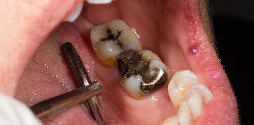 Europäischer Rat stimmt für Amalgam-Ausstieg 2025