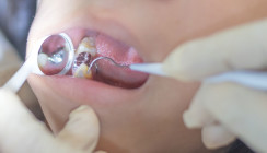 FDA gibt neue Leitlinie für Amalgamfüllungen heraus