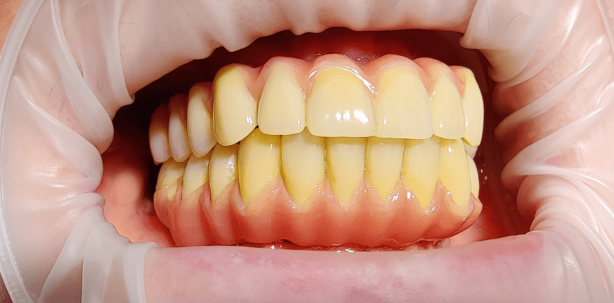 Teamwork in Prothetik, Chirurgie & Zahntechnik hilft Angstpatienten