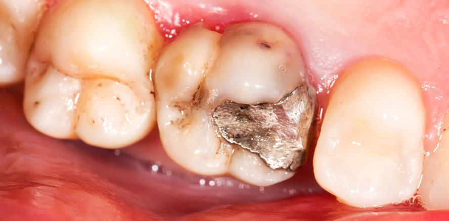 Anteil von Amalgamfüllungen sinkt kontinuierlich