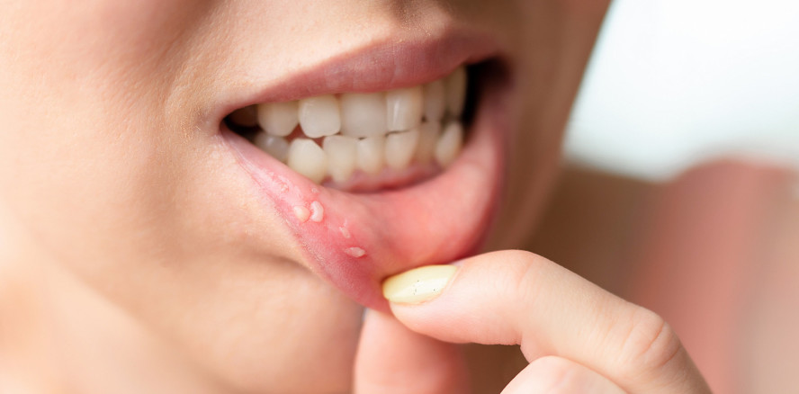 Aphthen: So lassen sich die Schmerzen im Mund lindern
