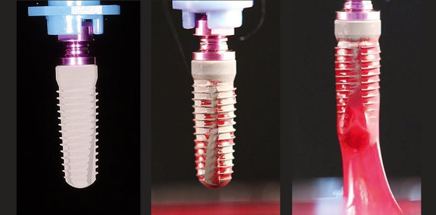 Wirkung von kaltem Atmosphärenplasma auf Titanimplantatoberflächen