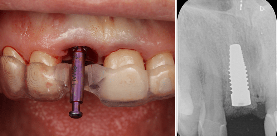 Atraumatische Extraktion und Sofortimplantation