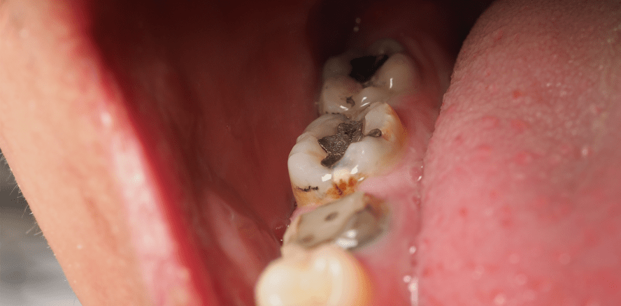 SDI stellt Amalgam-Produktion ab 2028 ein