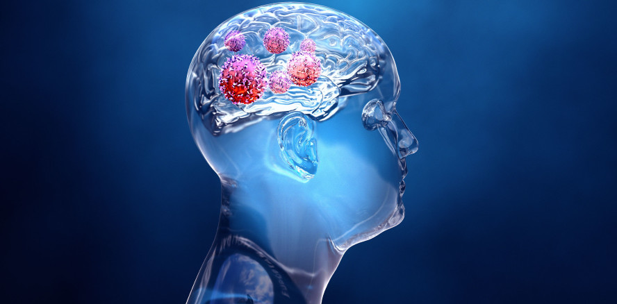 Bakterien im Mund als Auslöser für Hirnabszesse