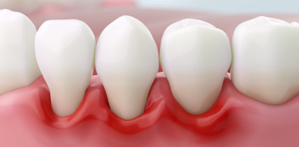 Cleveres Bakterium: Wie P. gingivalis das Immunsystem austrickst