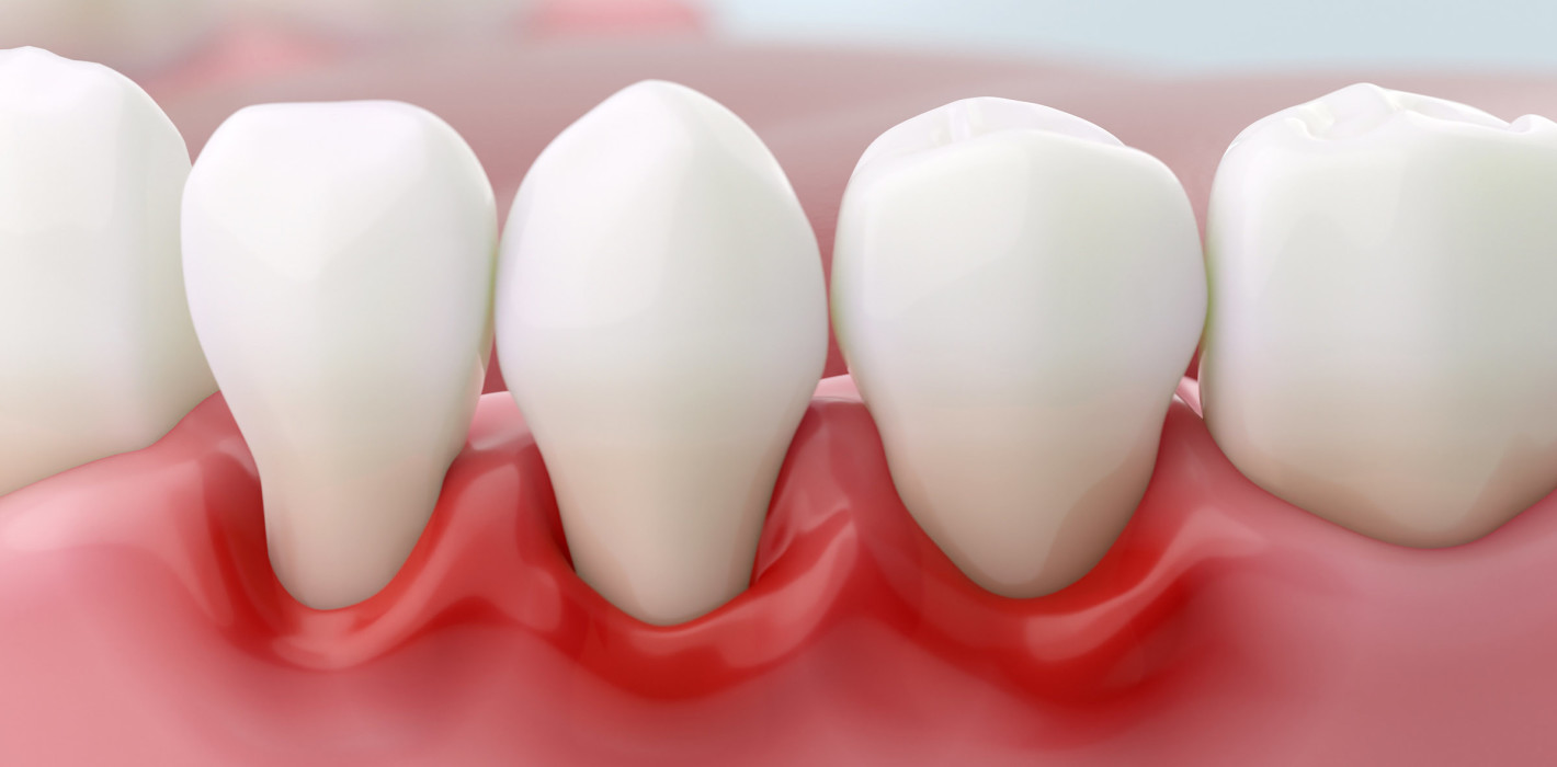 Cleveres Bakterium: Wie P. gingivalis das Immunsystem austrickst
