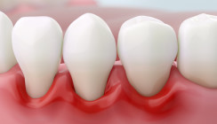 Cleveres Bakterium: Wie P. gingivalis das Immunsystem austrickst
