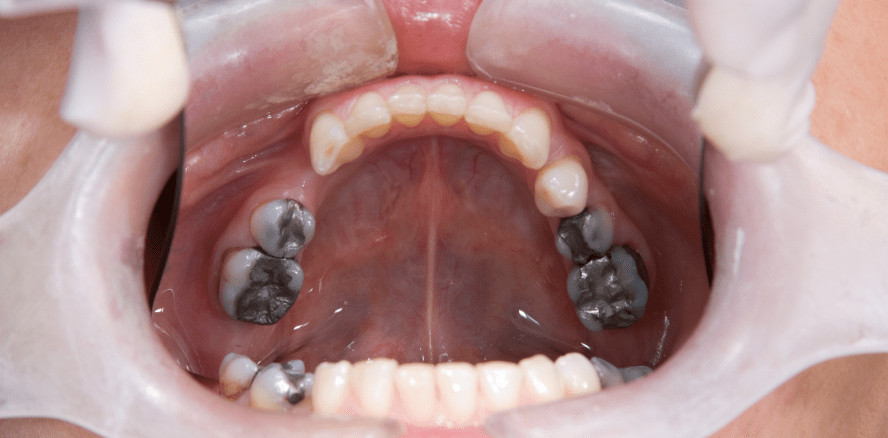 BARMER-Zahnreport: Regionale Unterschiede bei Amalgamfüllungen