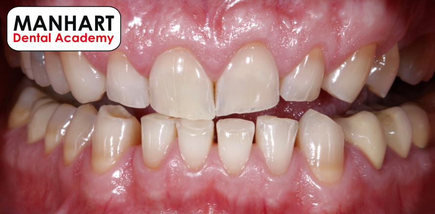 Bisshebung 2022 – Kurs für Zahnärzte und Zahntechniker