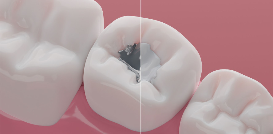 Schweiz unterstützt Einschränkung von Amalgam