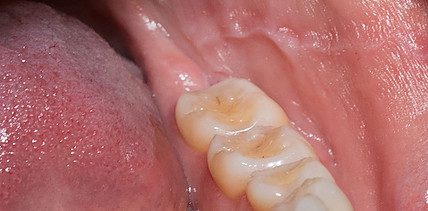Chronische Trockenheit, chronische Leiden? Das Sjögren-Syndrom im Fokus