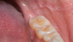 Chronische Trockenheit, chronische Leiden? Das Sjögren-Syndrom im Fokus