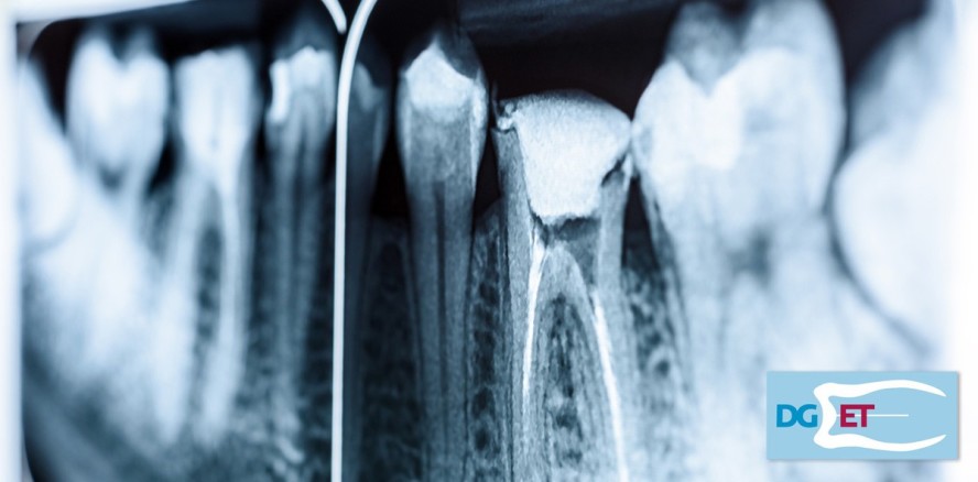 Curriculum Endodontie – Freie Plätze in München und Düsseldorf