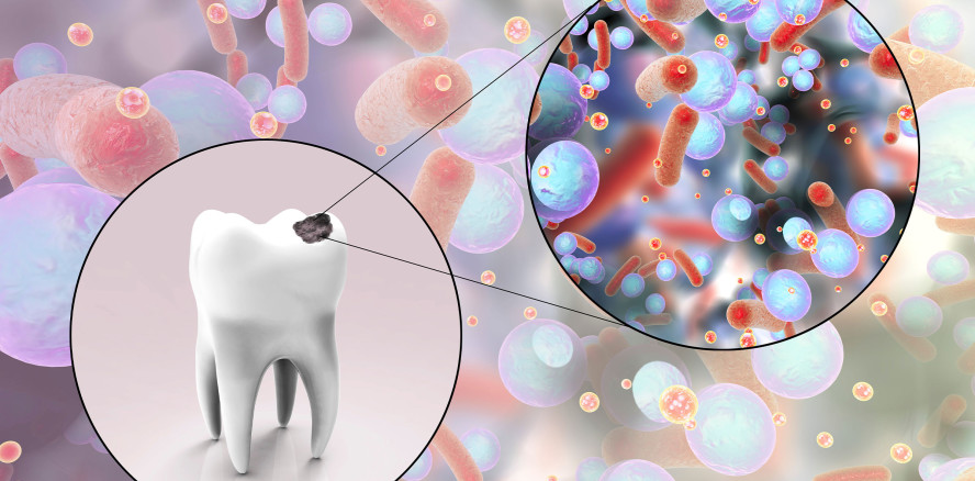 Deep Learning Algorithmus zur Erkennung von okklusalen Karies