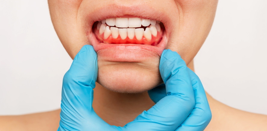 30 Millionen Deutsche sind an Parodontitis erkrankt