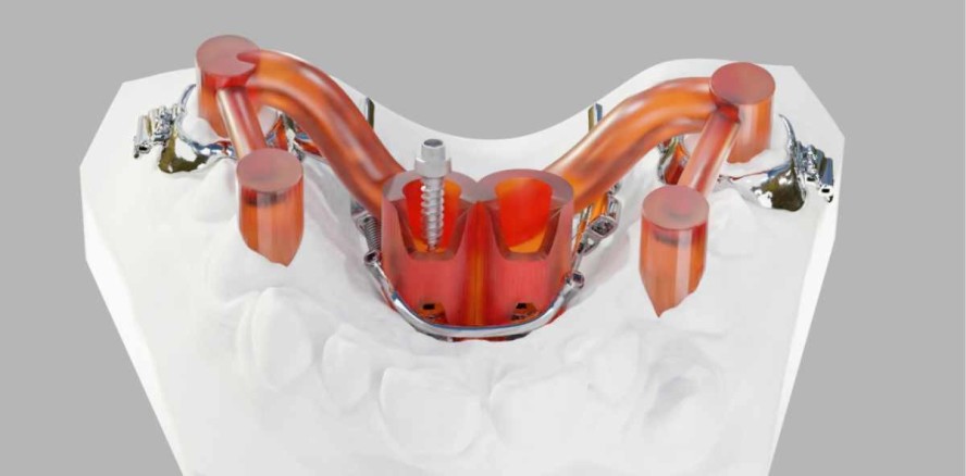 Full Digital Workflow beim Einsatz von Miniimplantaten