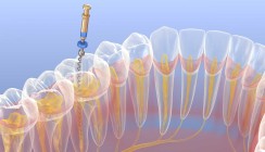 Digitale Geführte Therapie: Neuer Ansatz für die Endodontie