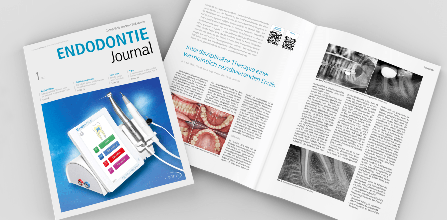 Interdisziplinäre Therapien im Fokus des aktuellen Endodontie Journal