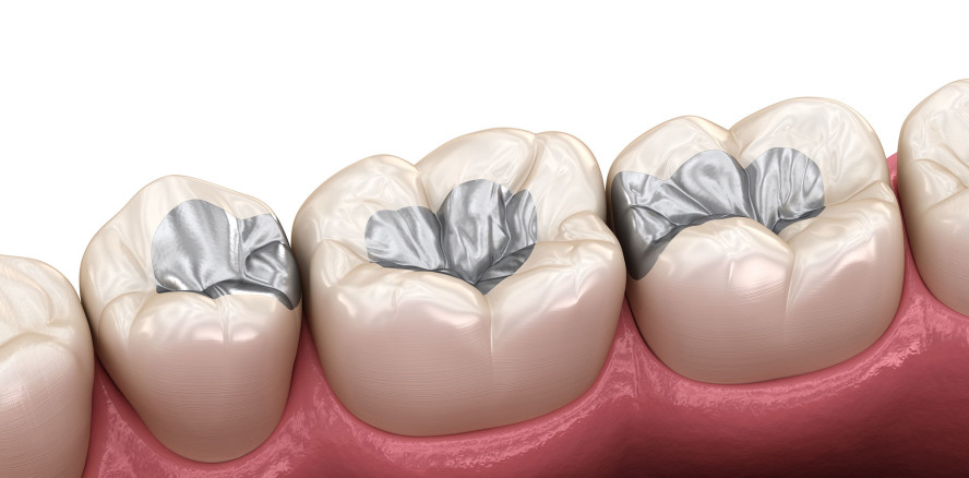 EU-Kommission empfiehlt Dentalamalgamverbot ab 2025