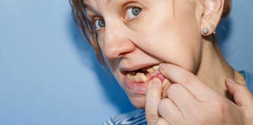 NHS-System und die Folgen: Patientin extrahiert selbst 11 Zähne