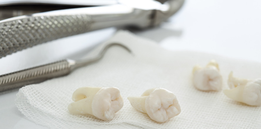 Entfernung von Weisheitszähnen kann Geschmackssinn verbessern