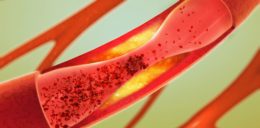 Entzündung der Herzinnenhaut bei unbehandelter Parodontitis