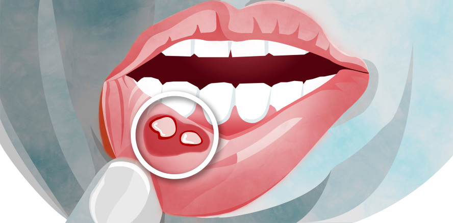 Entzündungen der Mundschleimhaut können Krebsbehandlung gefährden
