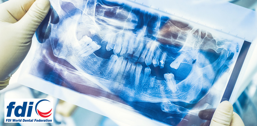 Teilbezahnte Patienten: Neuer Behandlungspfad der FDI vorgelegt