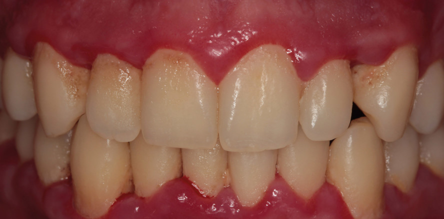 Komplikationen während und nach der zahnärztlichen Prophylaxe