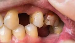 Fehlbiss mit Langzeitfolgen: Unterbiss erhöht Risiko für Zahnverlust