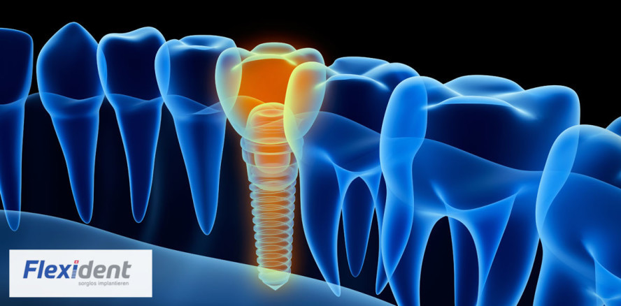 Flexident: Innovative Schulung zum digitalen Workflow